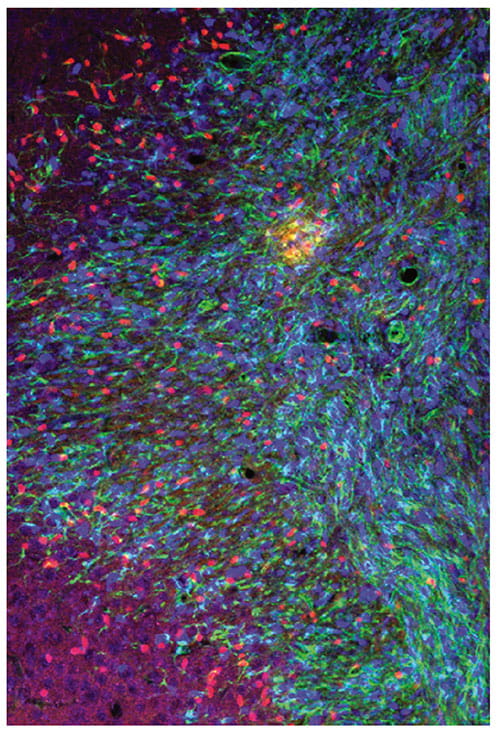 Fig A: This confocal microscope image shows brain cells from adult mice expressing the protein Olig2 (shown in red). Re-searchers at Cincinnati Children’s discovered that inhibiting Olig2 appears to make aggressive, high-grade gliomas significantly more sensitive to treatment.
